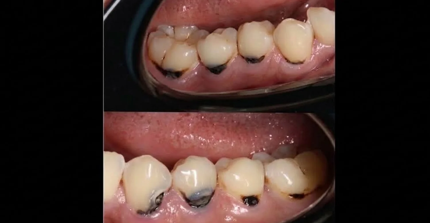 Gum Line Cavity1